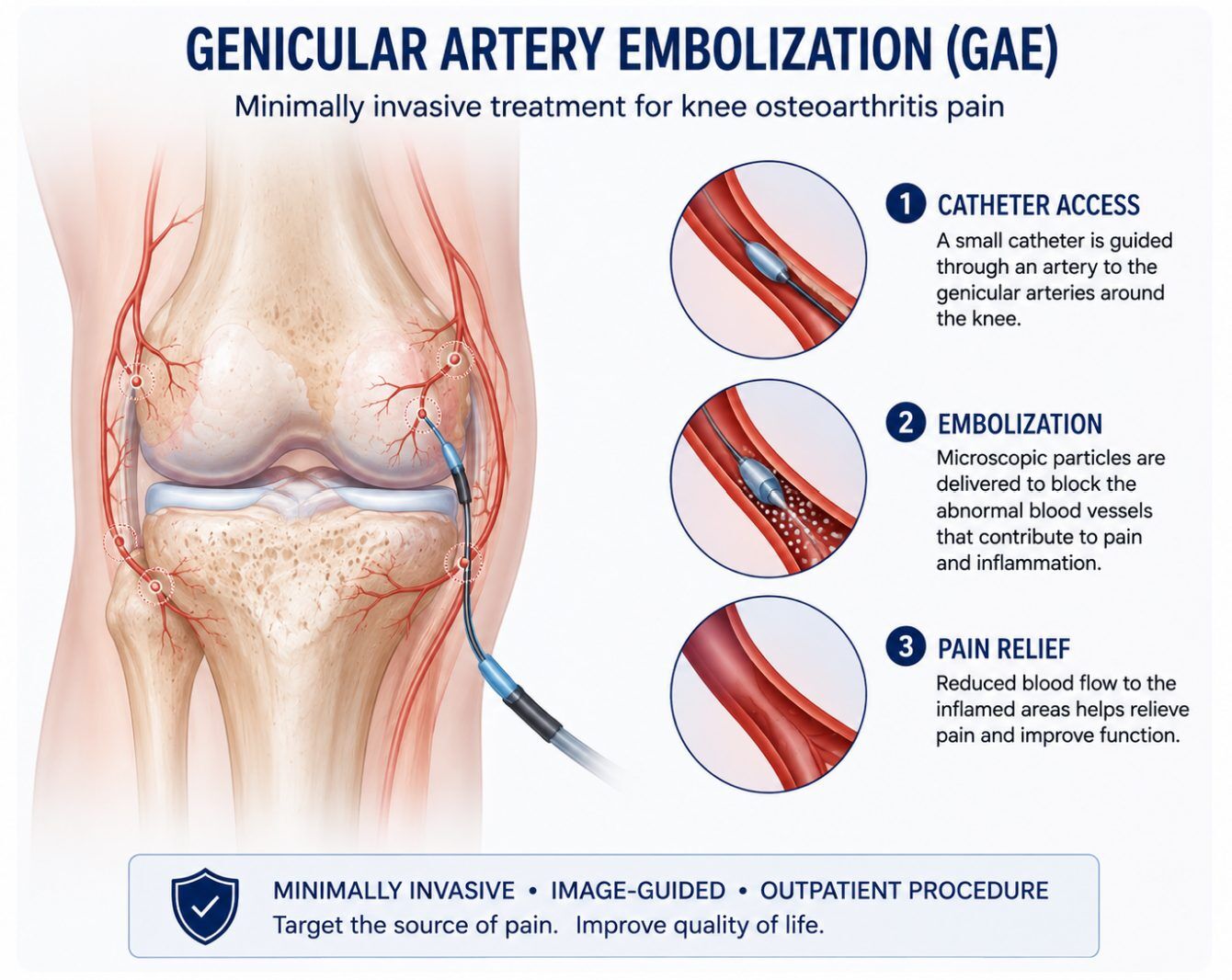 Infographic: how genicular artery embolization works in three steps