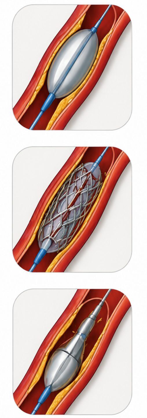 Ilustración de angioplastia, stent y aterectomía dentro de una arteria