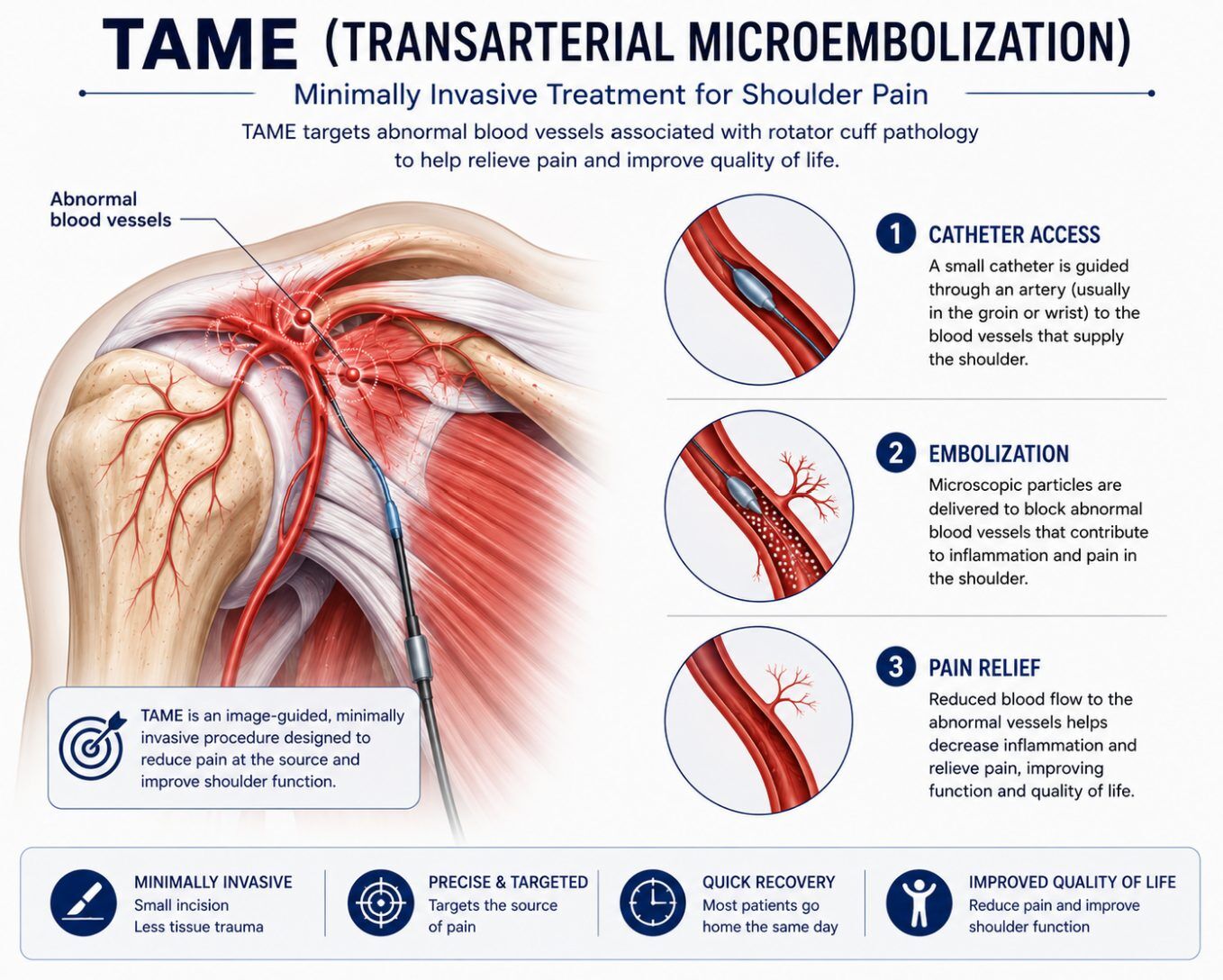 Infografía: cómo la microembolización transarterial trata el dolor de hombro